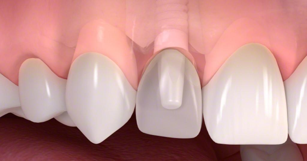 keramikimplantat keramikimplantat